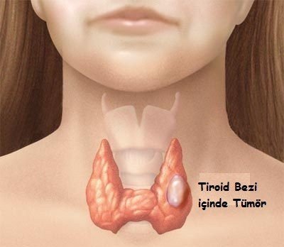 Tiroid kanseri neden olur?